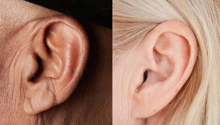 Oticon: Im-Ohr-Gerät im Ohr