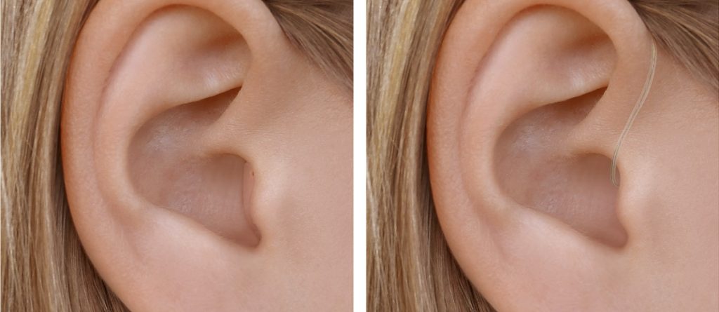 Zwei Ohren mit Widex Moment Hörgeräten: Links CIC, rechts RIC