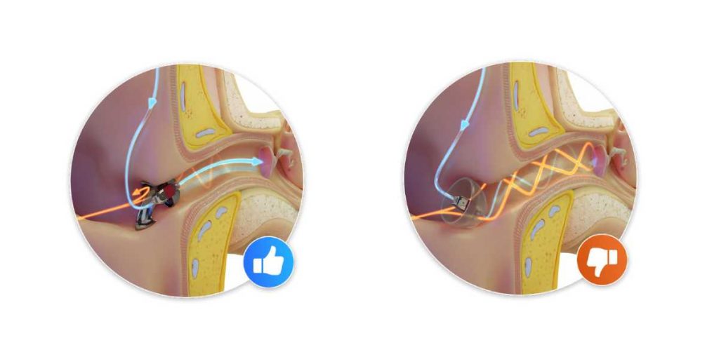 Darstellung Hörgerät Otoplastik vs. Hörgerät Schirmchen
